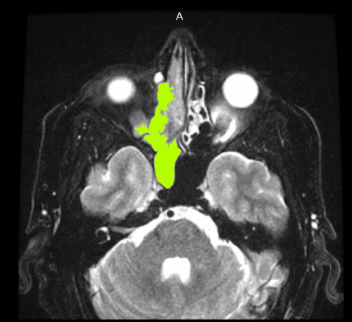 MRI internal scan beneath my brain - 2011.04.19