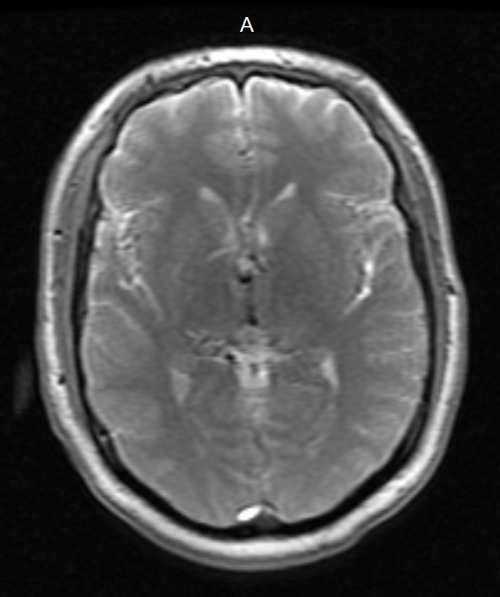 MRI Topdown-looking scan 2011.04.19